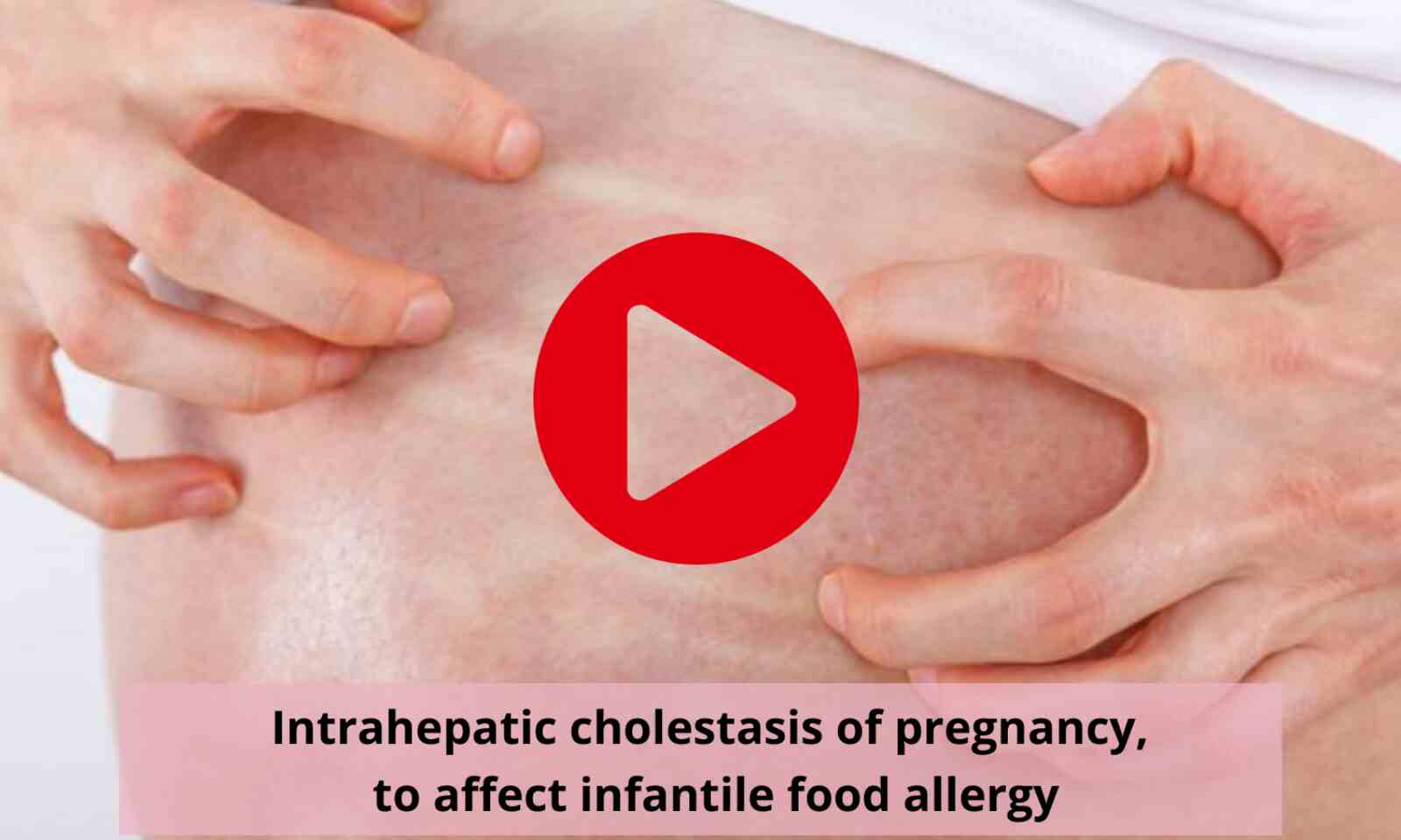 intrahepatic cholestasis of pregnancy