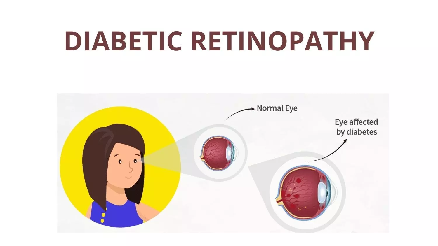 Diabetic retinopathy