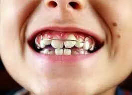 Deleterious oral habits tied with different types of malocclusions in children