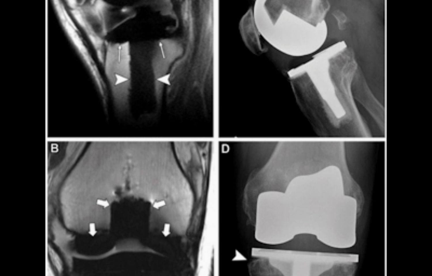 mri-can-better-diagnose-patellar-component-loosening-after-knee-surgery