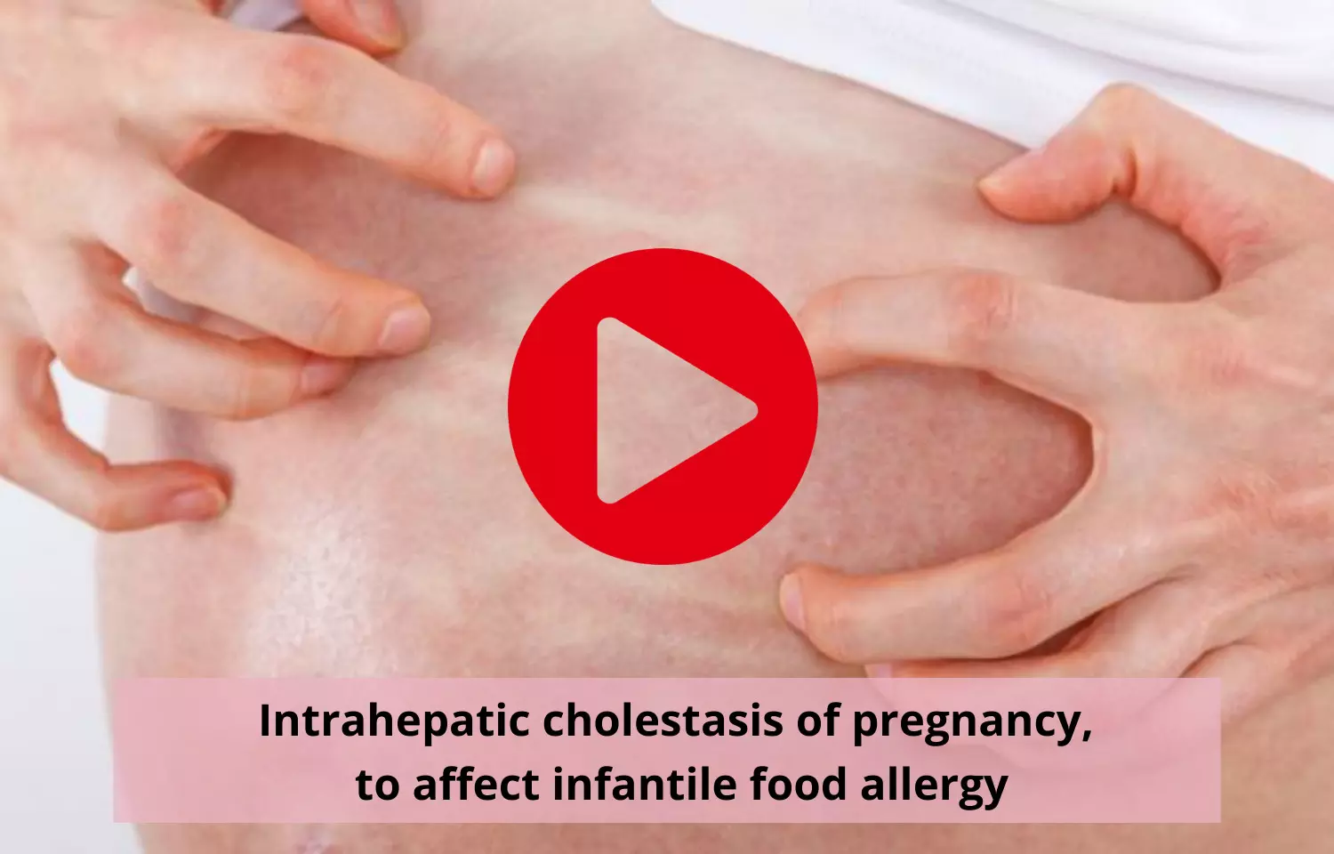 Intrahepatic cholestasis of pregnancy, to affect infantile food allergy
