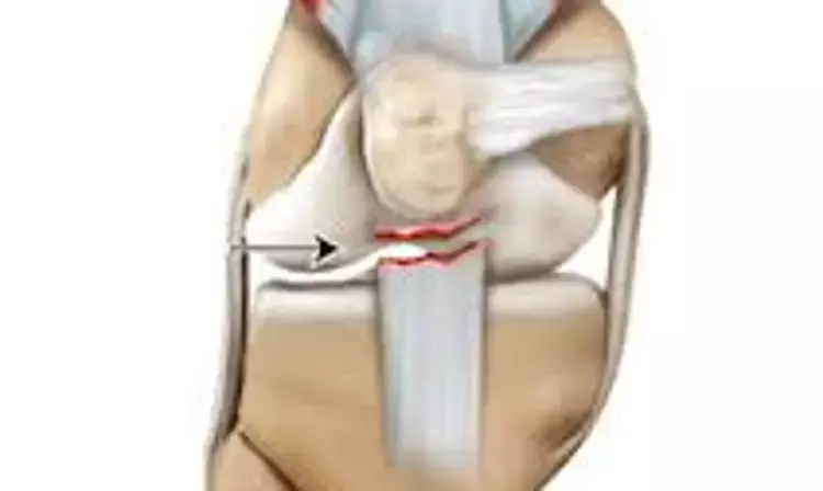 New Surgical Technique of Patellar Tendon Reconstruction in TKA Using Achilles Tendon Allograft