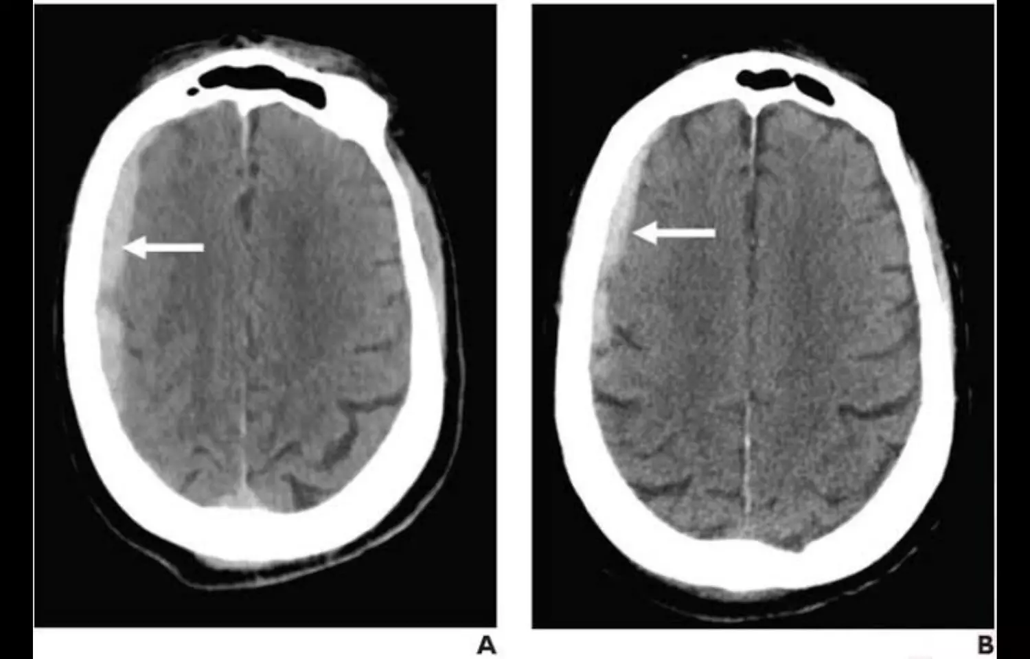 Antithrombotic therapy not associated with increased traumatic ICH on CT in adults