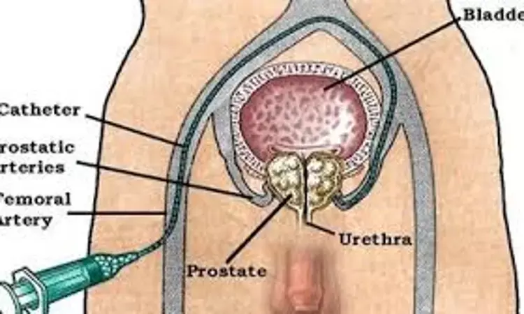 Prostate Artery Embolization significantly improves symptoms of lower urinary tract