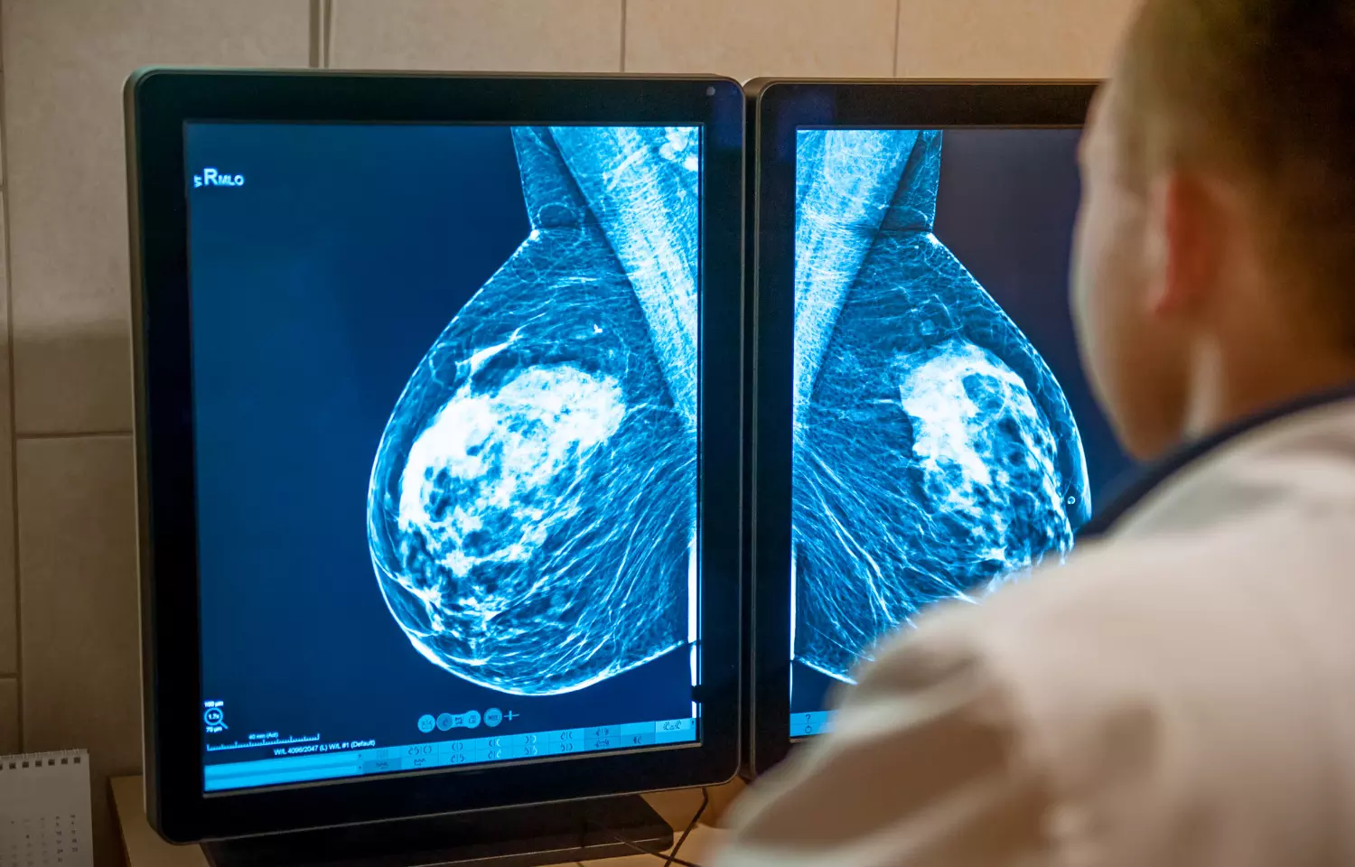 Half of all women experience false positive mammograms after 10 years of annual screening