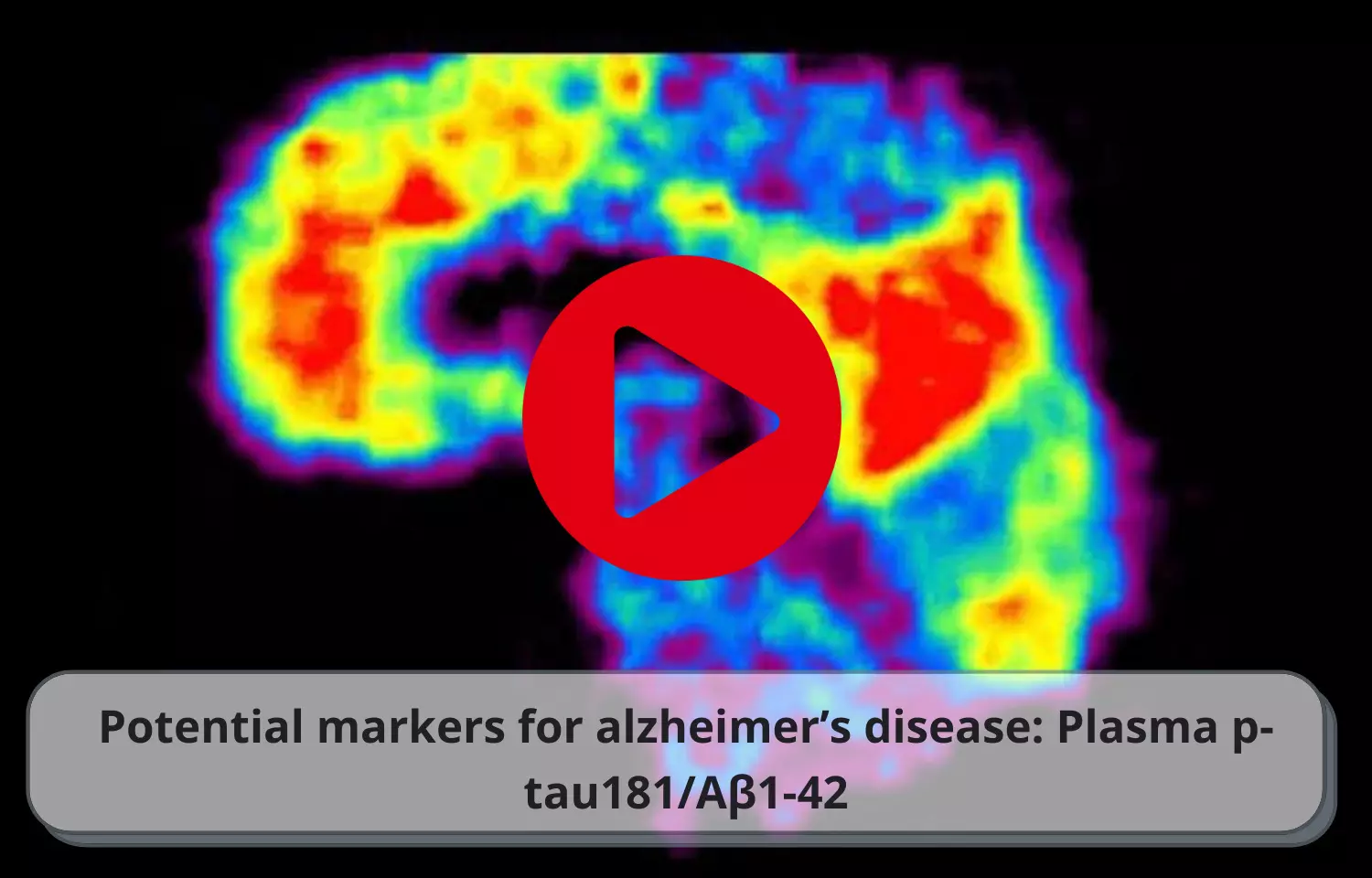 Potential markers for alzheimers disease: Plasma p-tau181/Aβ1-42