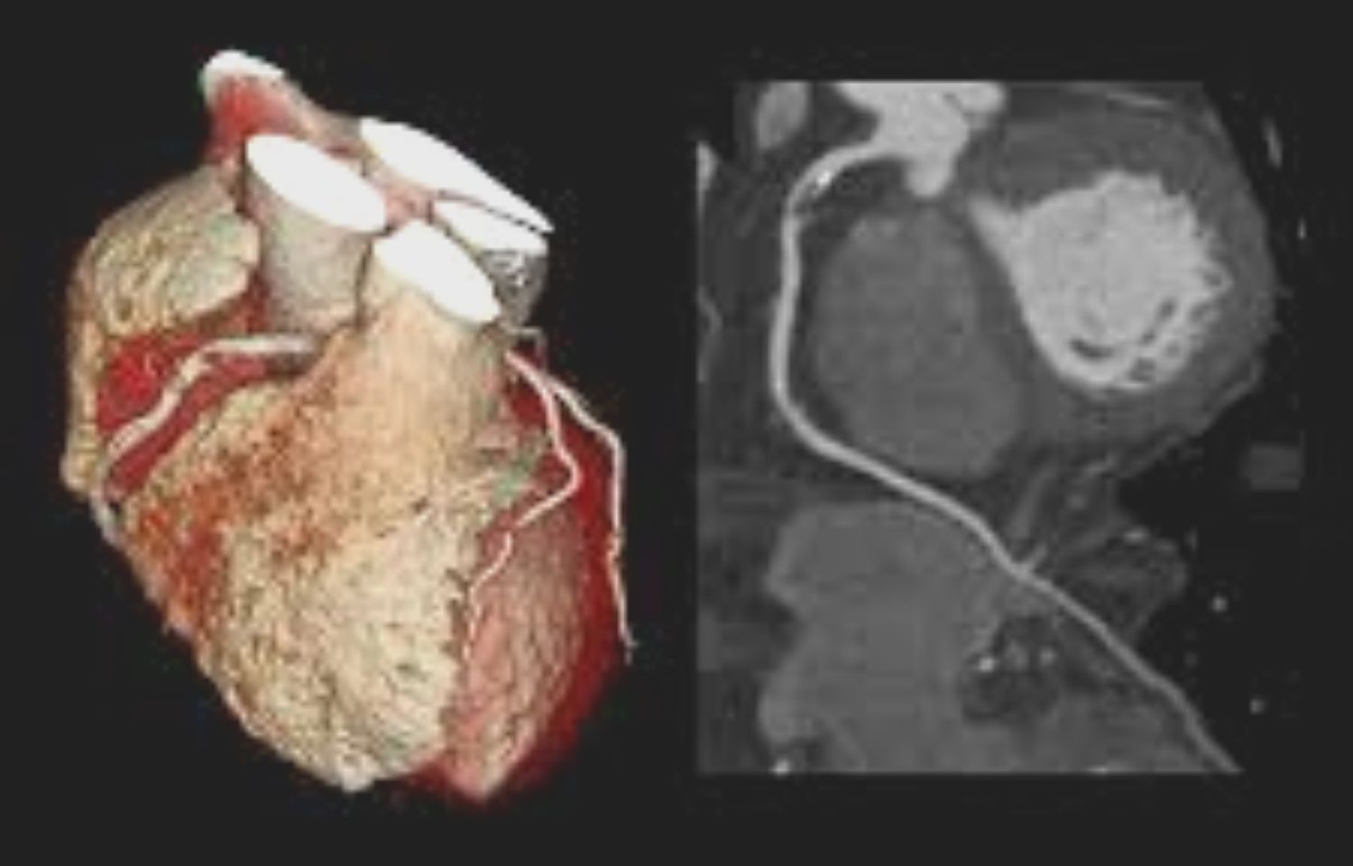 Фото сосудов сердца. Мультиспиральная кт сердца сосудов сердца. Кт-ангиография коронарных артерий. МСКТ-коронарография сердца. Кт коронарография сосудов сердца.