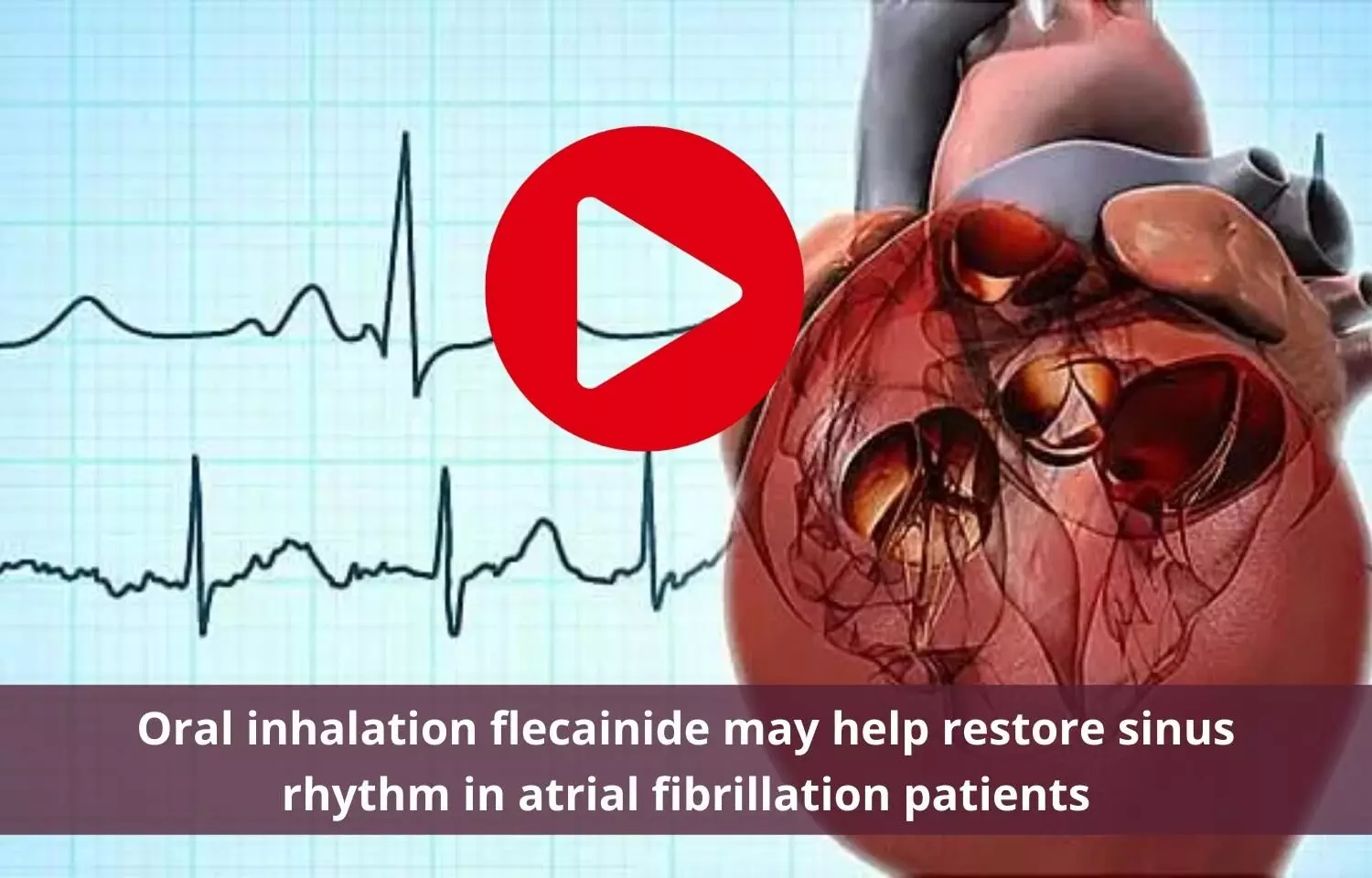 Oral inhalation flecainide may help restore sinus rhythm in atrial fibrillation patients