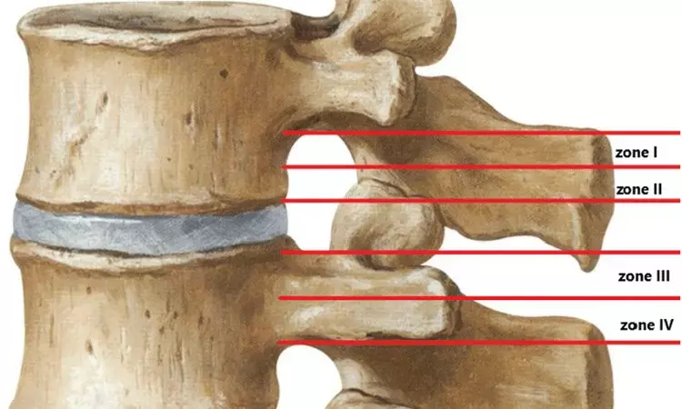 Complication rates of 3 posterior decompression techniques for lumbar spinal stenosis almost same: JAMA