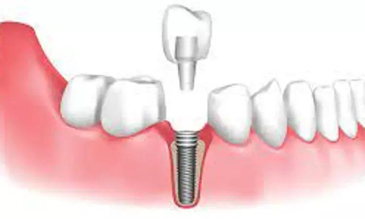 Upto 10% of patients receiving dental implants develop postoperative infections: Study