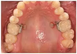 Smooth tooth surfaces & restorative material blocks show similar in situ plaque composition: Study