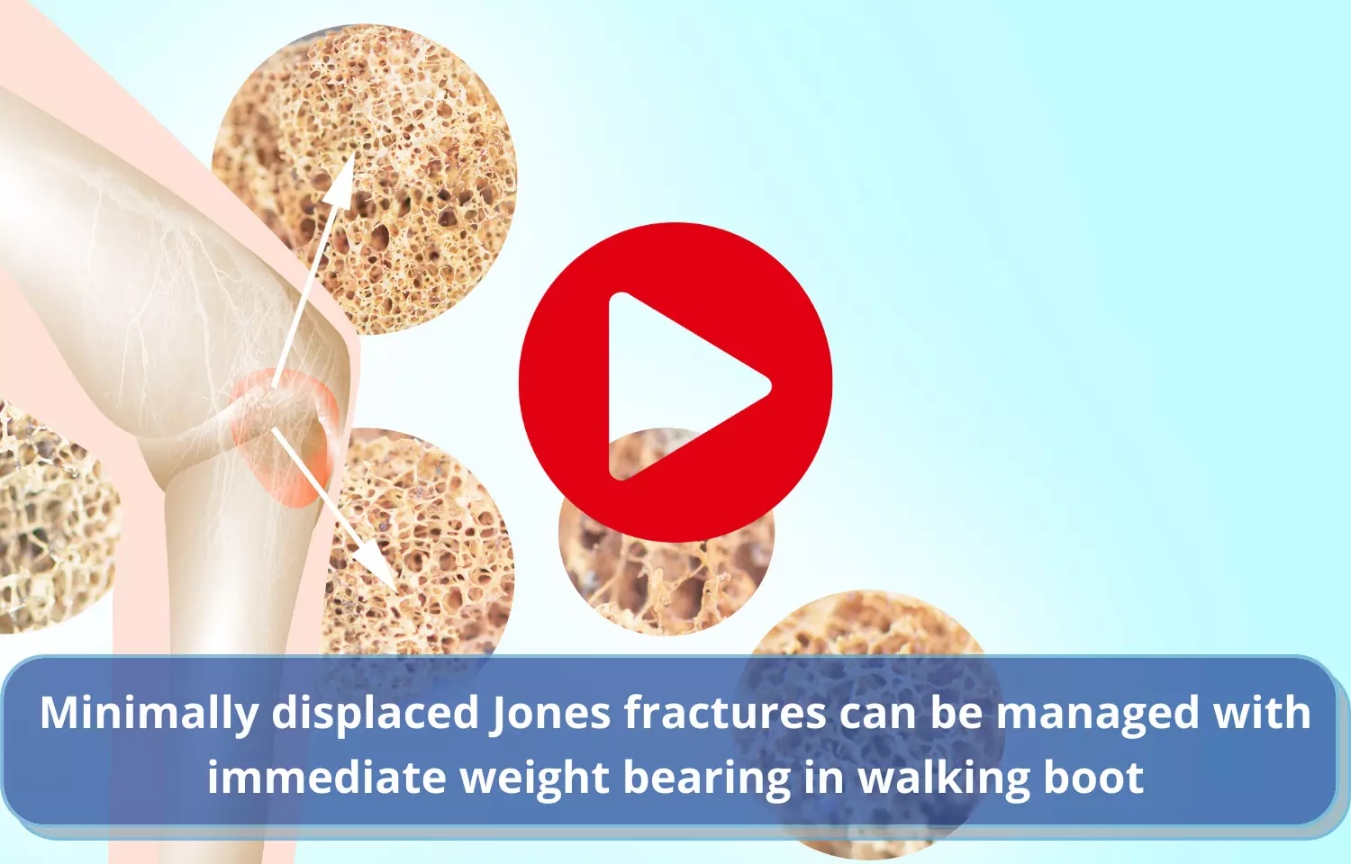 Minimally displaced Jones fractures to be managed with immediate weight bearing in walking boot