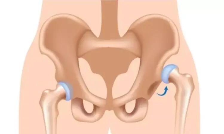 New technique for proximal femoral resection in non-ambulatory patients with cerebral palsy