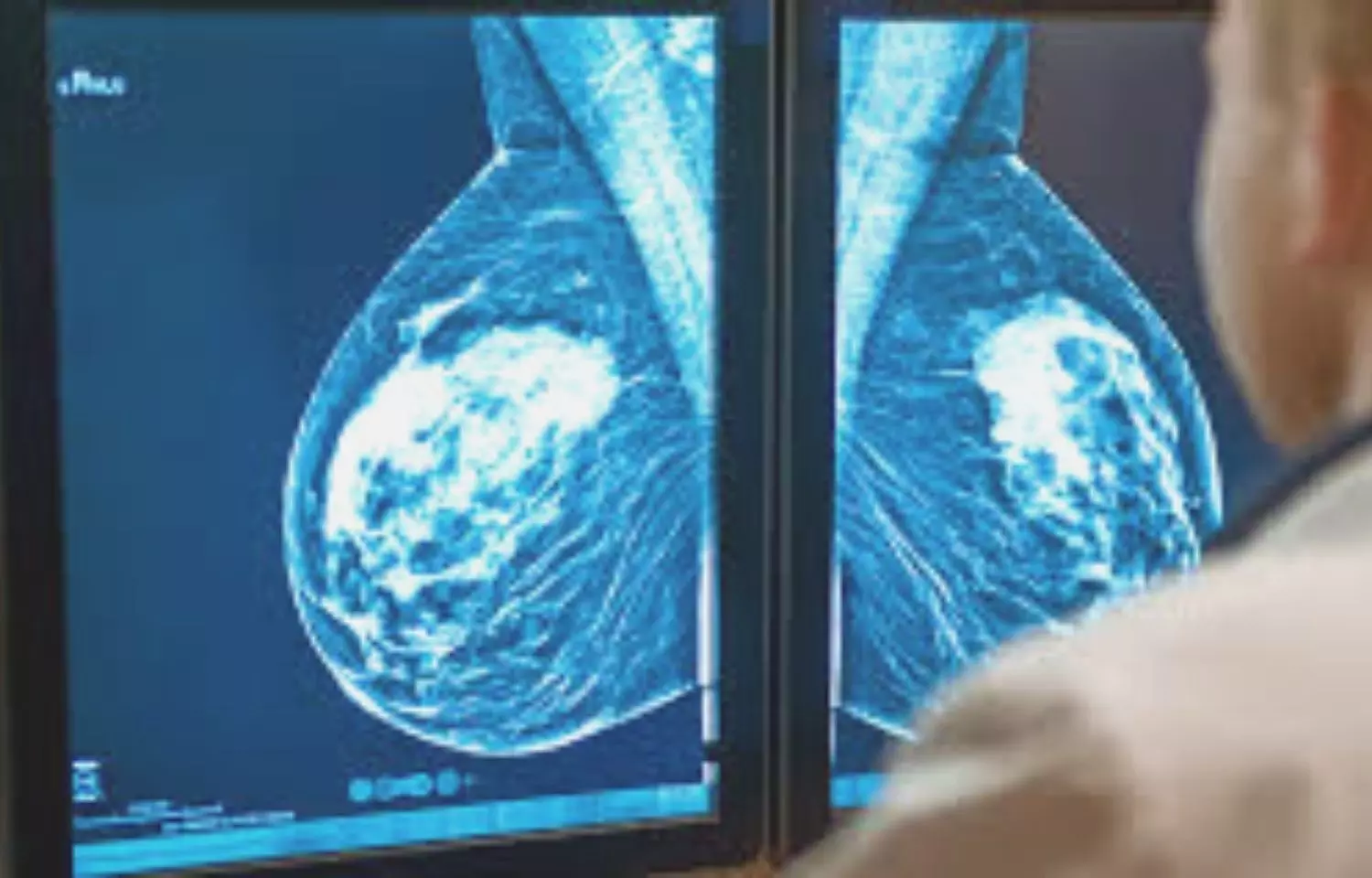 Ultrasound more accurate for assisting breast cancer treatment: Study