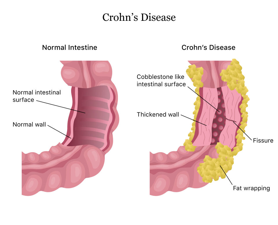 crp-12-mg-l-may-predict-severity-of-ulcerative-colitis-instead-of-esr