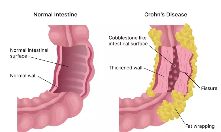 Risankizumab safe and effective maintenance therapy for Crohns Disease: Lancet