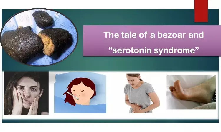 Rare case of Serotonin syndrome due to therapeutic dose of Tramadol, bezoar underlying culprit