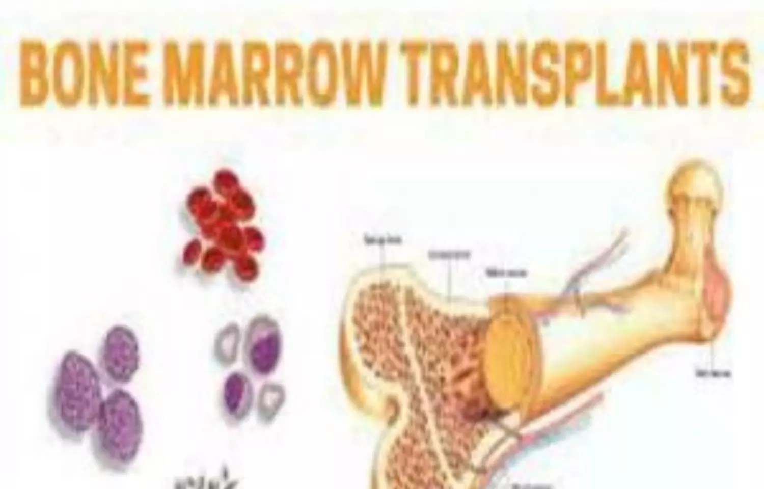Madhya Pradesh to get four Marrow Transplant and Pediatric Cancer Units