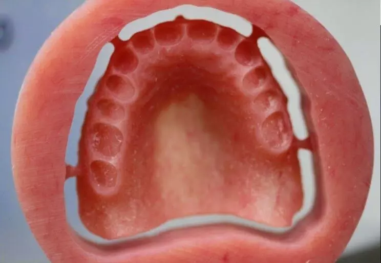 Methylmethacrylate concentrations significantly lower in 3D-printed removable complete dentures