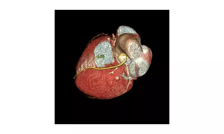 Diltiazem may not improve coronary vasomotor dysfunction in angina and ANOCA- EDIT CMD Trial