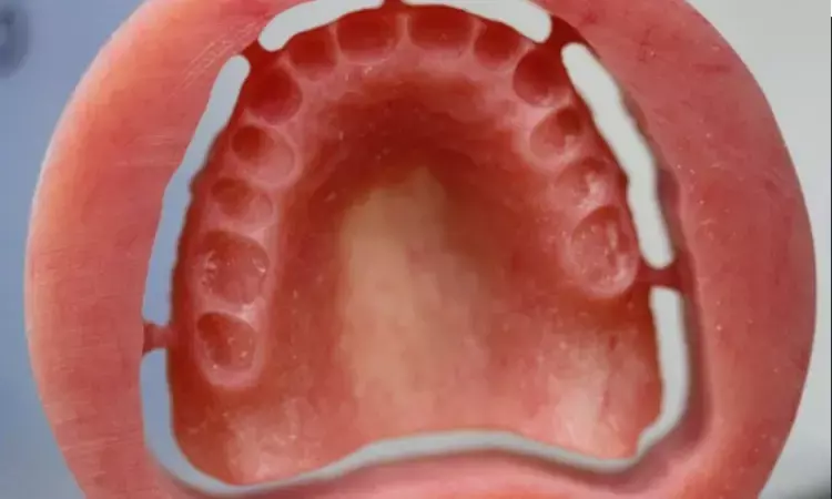 Methylmethacrylate concentrations significantly lower in 3D-printed removable complete dentures