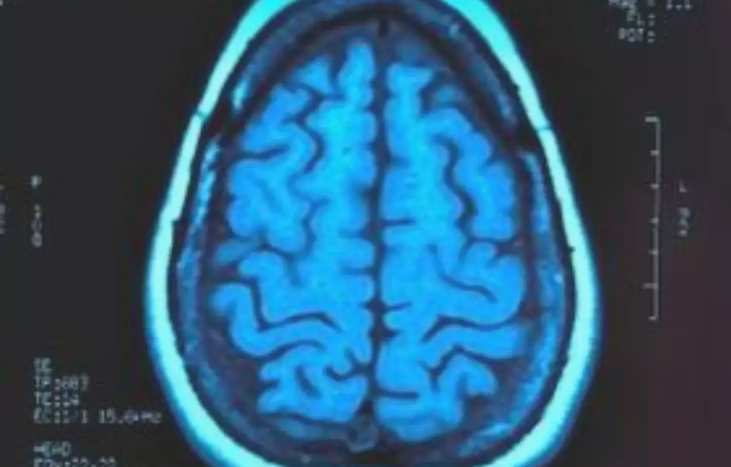 MRI can detect onset of autism during infancy, study finds