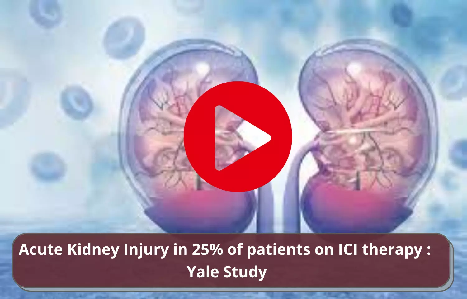 Acute Kidney Injury in 25% of patients on ICI therapy: Yale Study