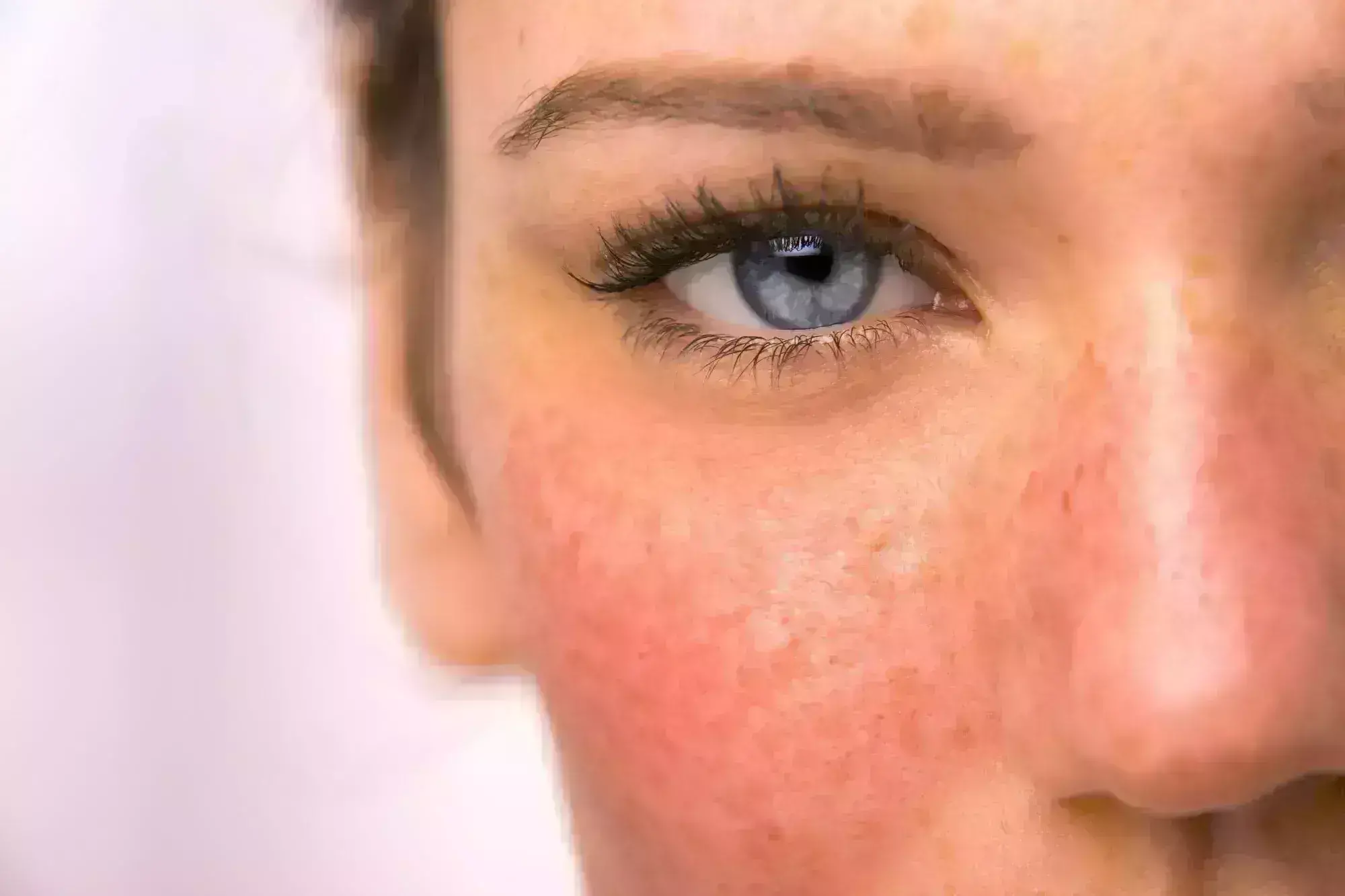 Microbotox Shows Promising Results in Treatment of Acne and Rosacea