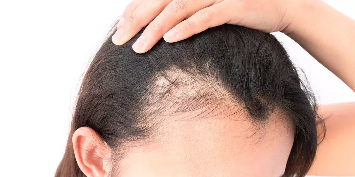 Androgenic alopecia patients at increased risk of developing metabolic syndrome