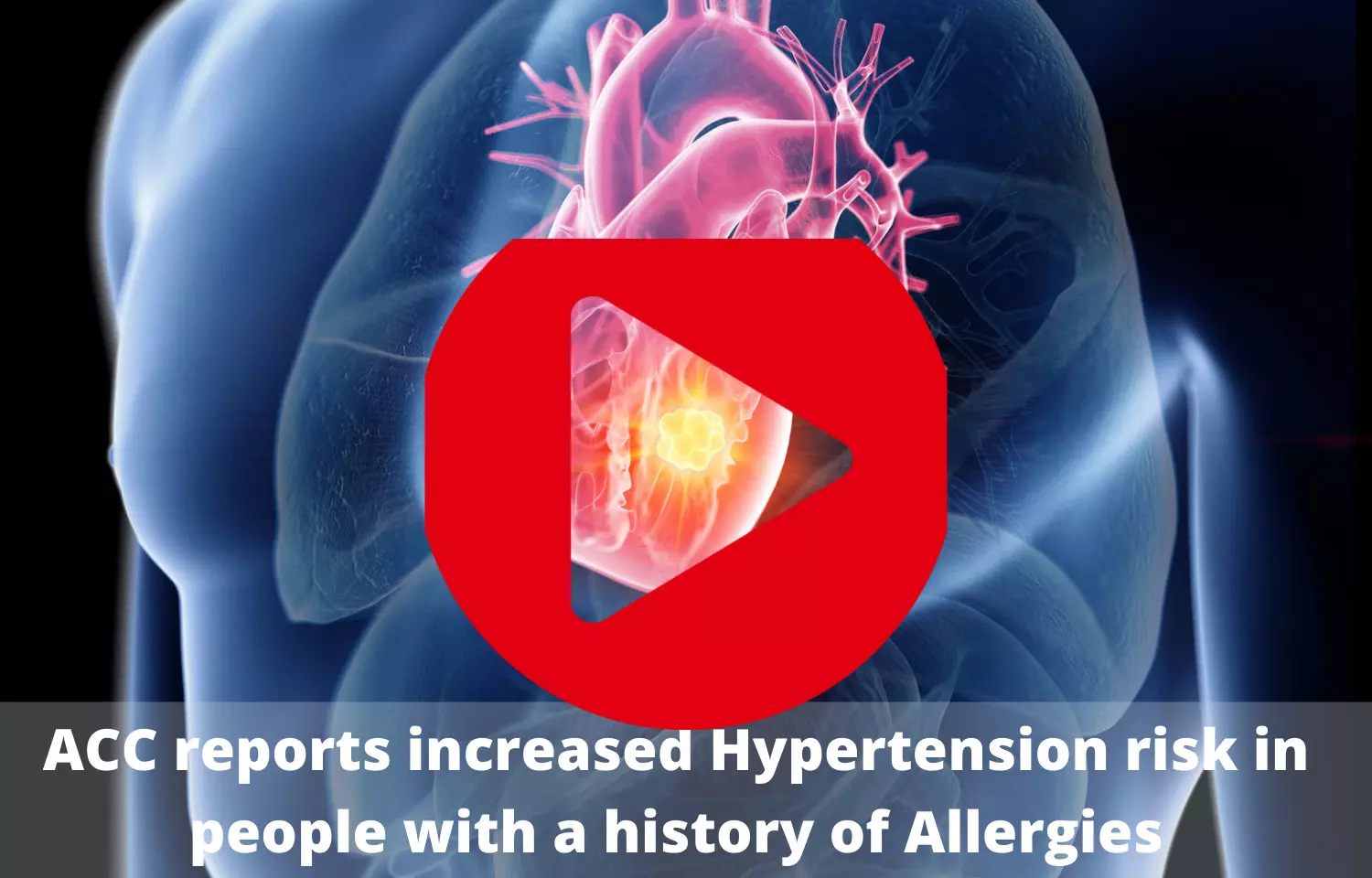 Journal Club - ACC reports increased hypertension risk in people with history of allergies