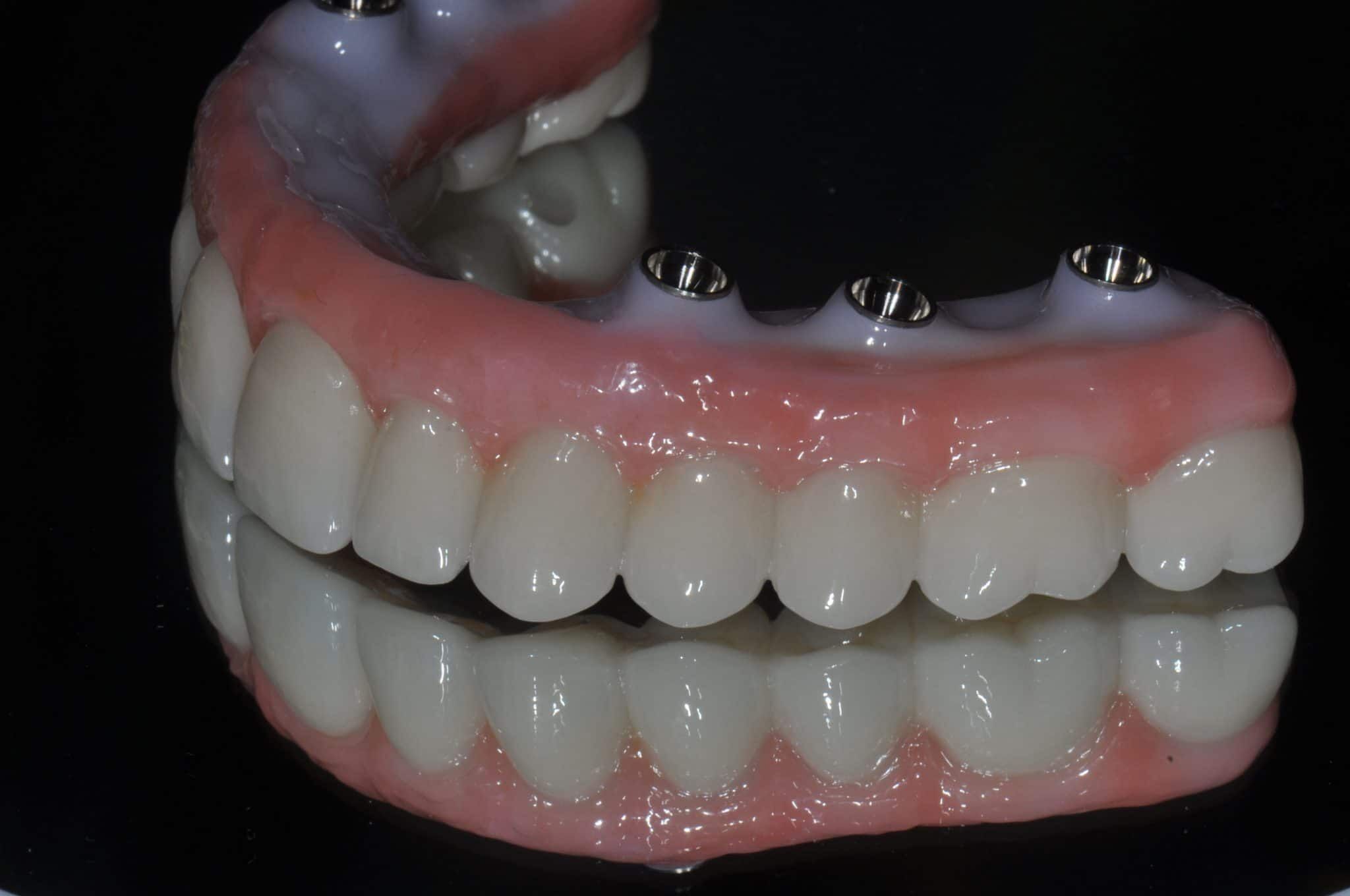 Fully personalized, abutmentfree monolithic zirconia CADCAM crowns