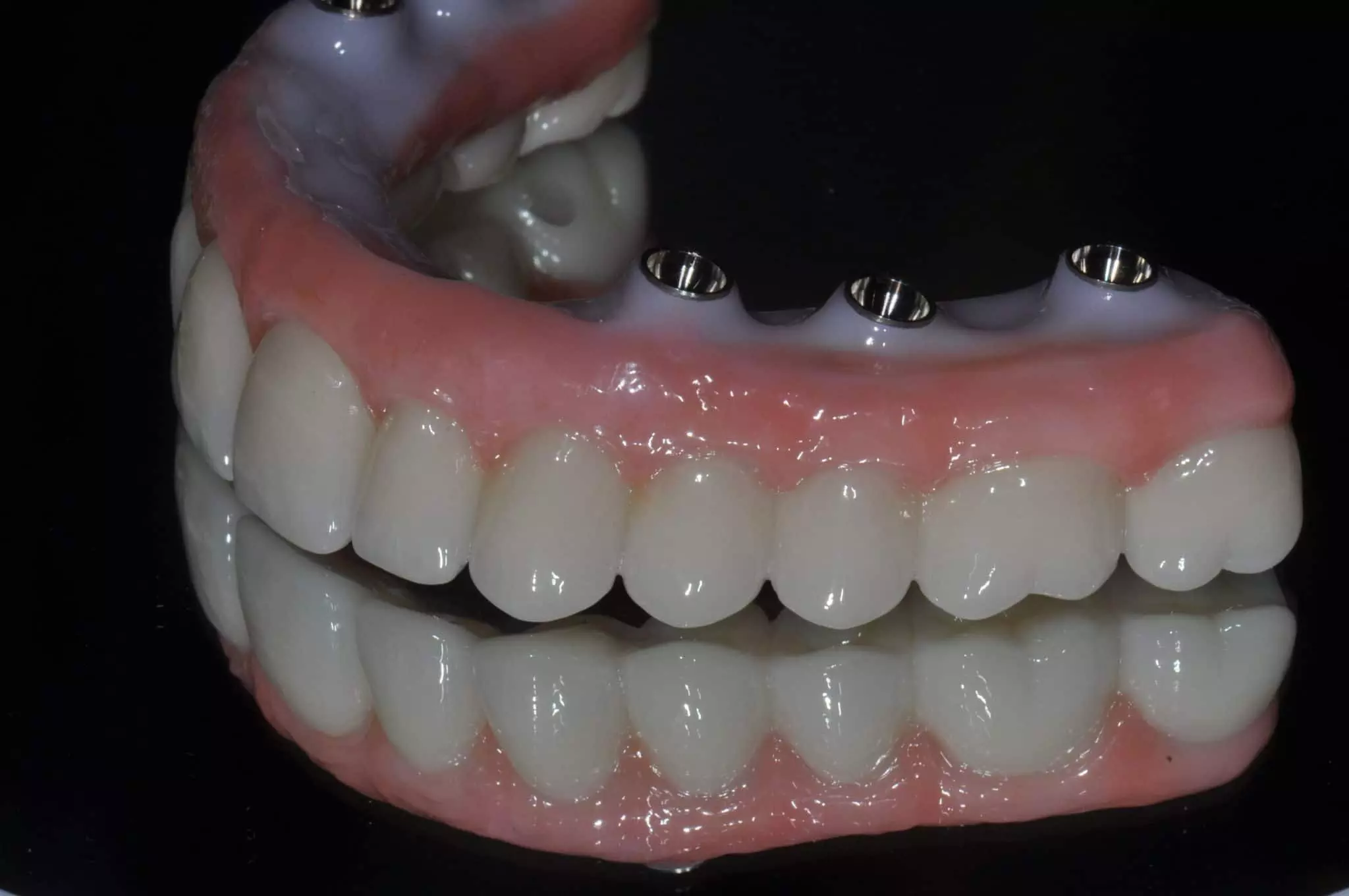 Fully personalized, abutment-free monolithic zirconia CAD-CAM crowns mechanically stable