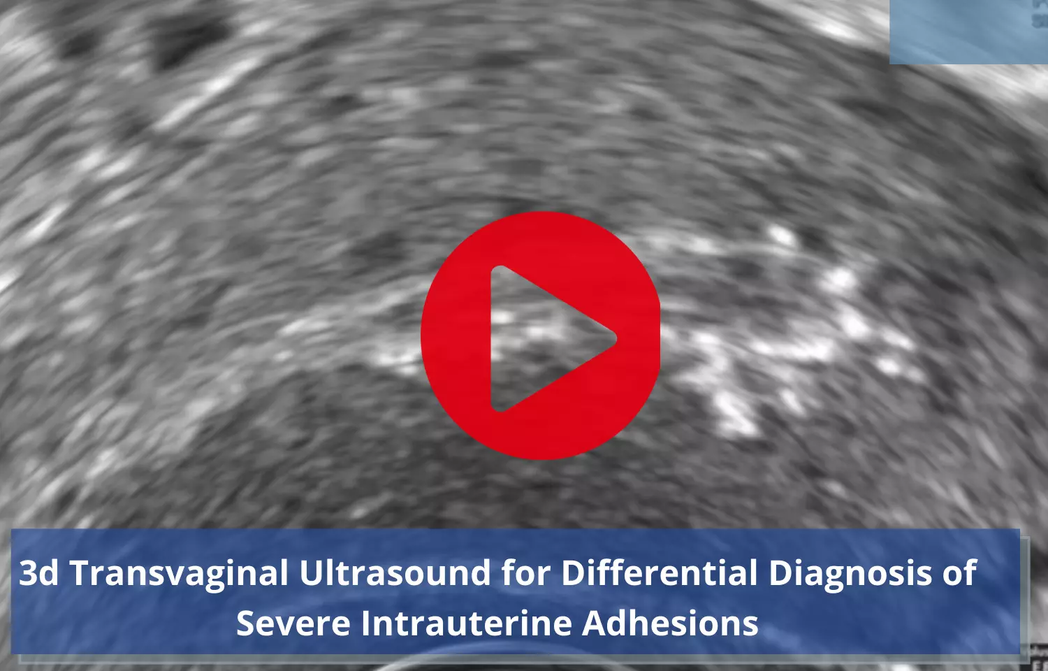 3D Transvaginal Ultrasound as Differential Diagnosis of Severe Intrauterine Adhesions