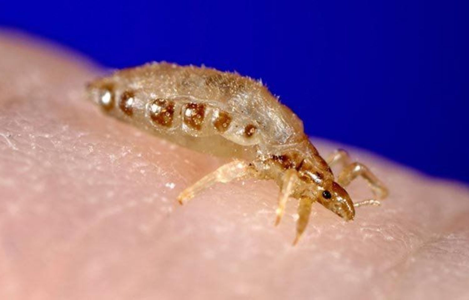 Long term body lice infestation tied to anemia- JAMA