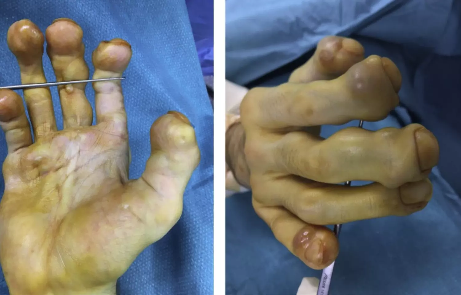 Atypical Presentation of Juvenile Hyaline Fibromatosis of Hands- A report