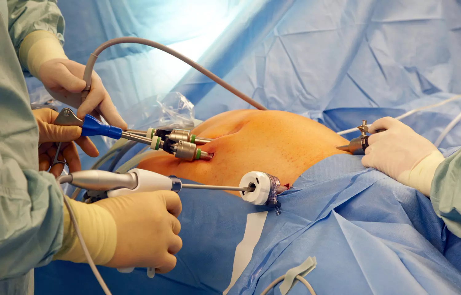 Less invasive, more precise surgery may be performed by a magnetic needle