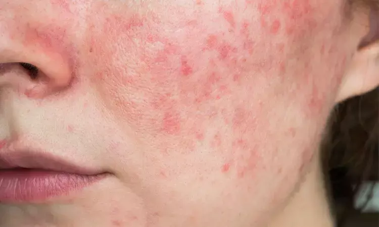 FDA approves Epsolay for inflammatory lesions of rosacea