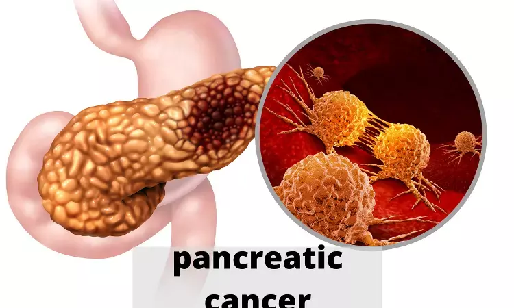 AI may detect earliest signs of pancreatic cancer