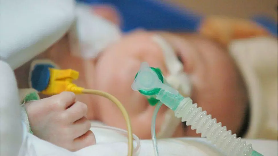 Nasal High-Flow therapy Ups Intubation Success in First Attempt Among Neonates