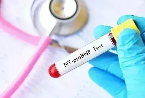 Is NT-proBNP reliable for heart failure diagnosis in Indian patients? Study provides insights