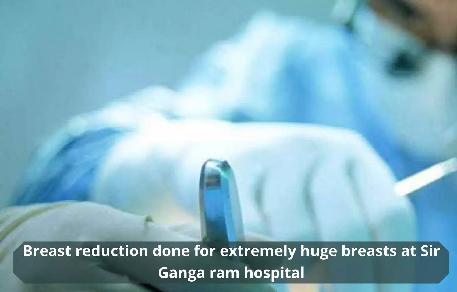 Breast reduction successful for extremely huge breasts at Sir Ganga ram hospital