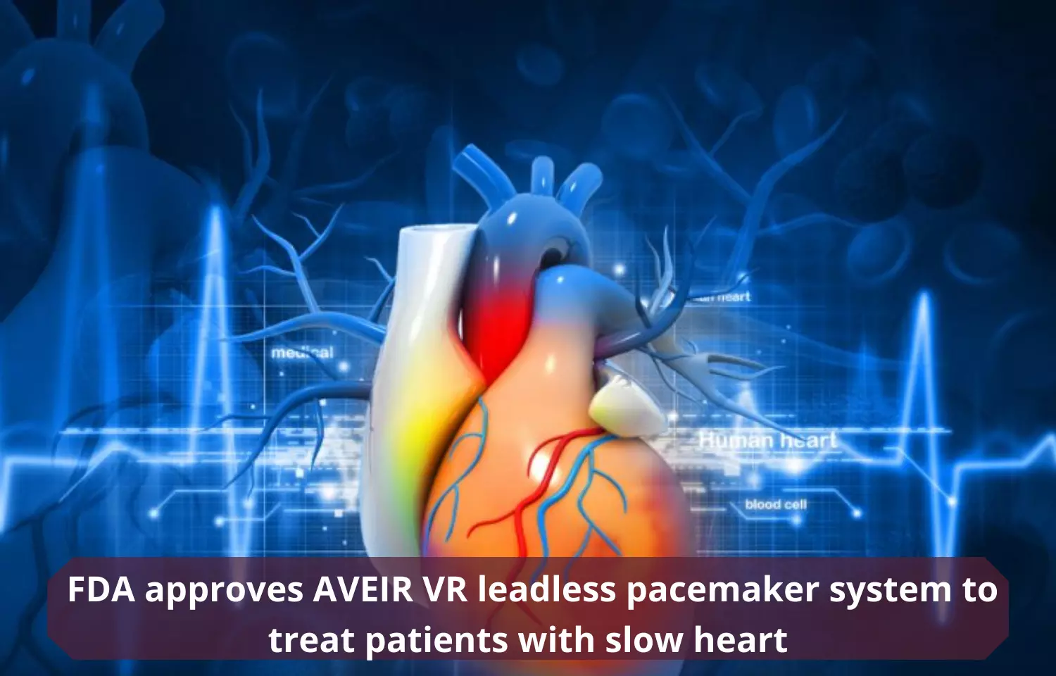 Journal Club - FDA approves AVEIR VR leadless pacemaker system to treat patients with slow heart