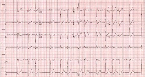 Elevated Lp(a) levels increase risk of Atrial fibrillation