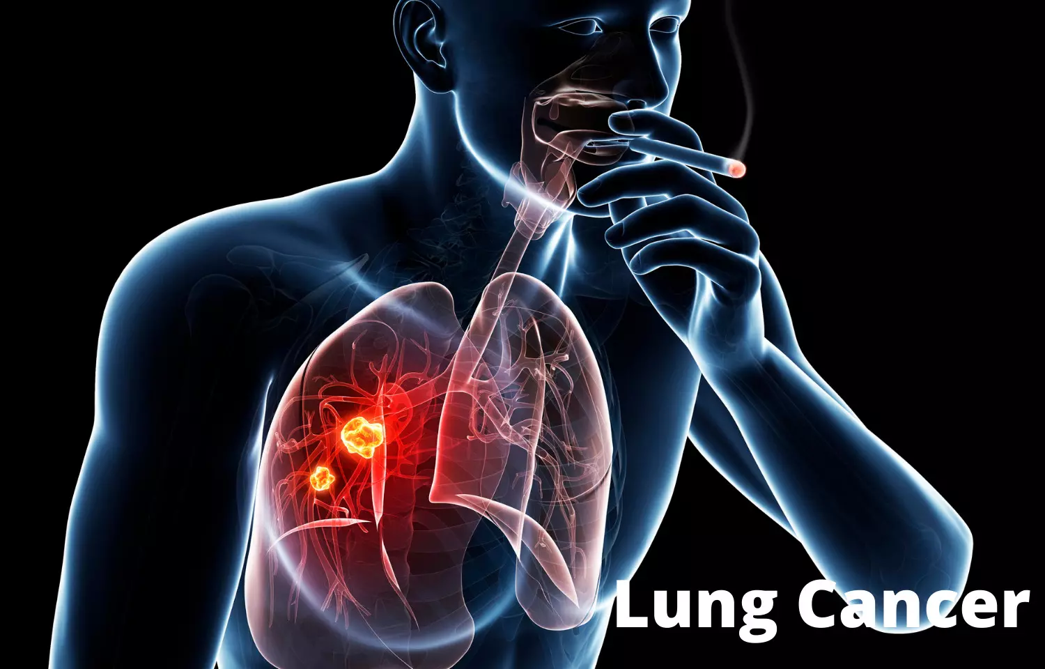 CT-detected emphysema associated with higher lung cancer risk