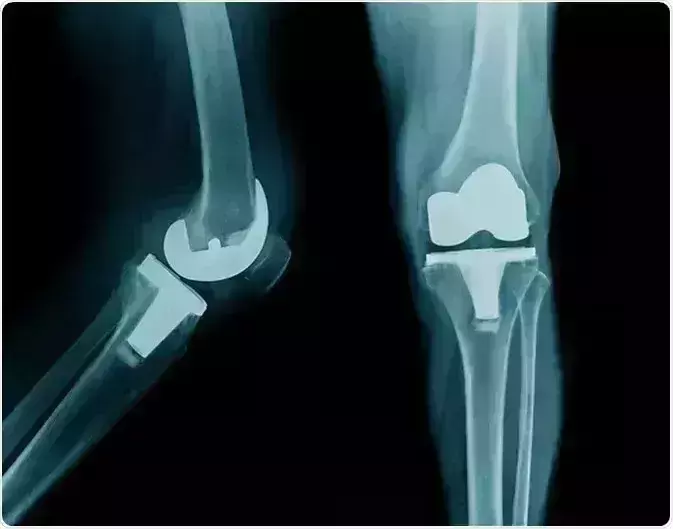 Telangana: Knee replacement surgery now at all Government hospitals