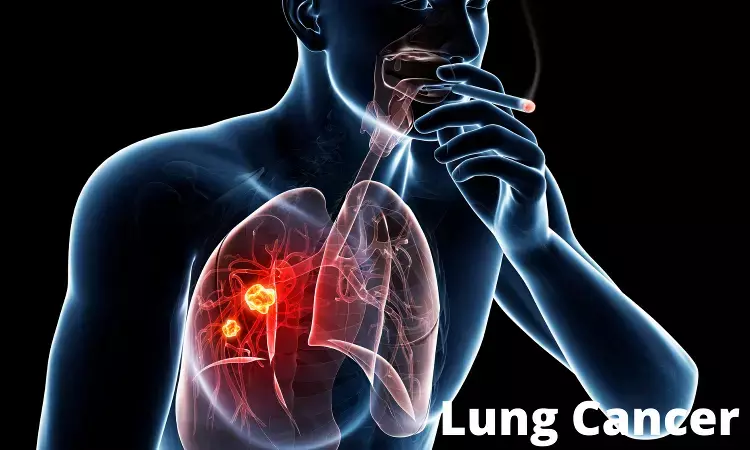 CT-detected emphysema associated with higher lung cancer risk