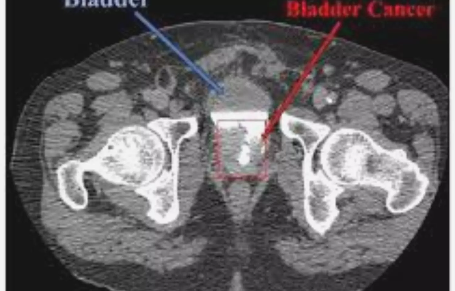 Computed tomography-urography with CMP can exclude bladder cancer: BMC Urology