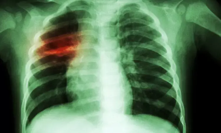 New Clinical Practice Guidelines on Idiopathic Pulmonary Fibrosis and Progressive Pulmonary Fibrosis released