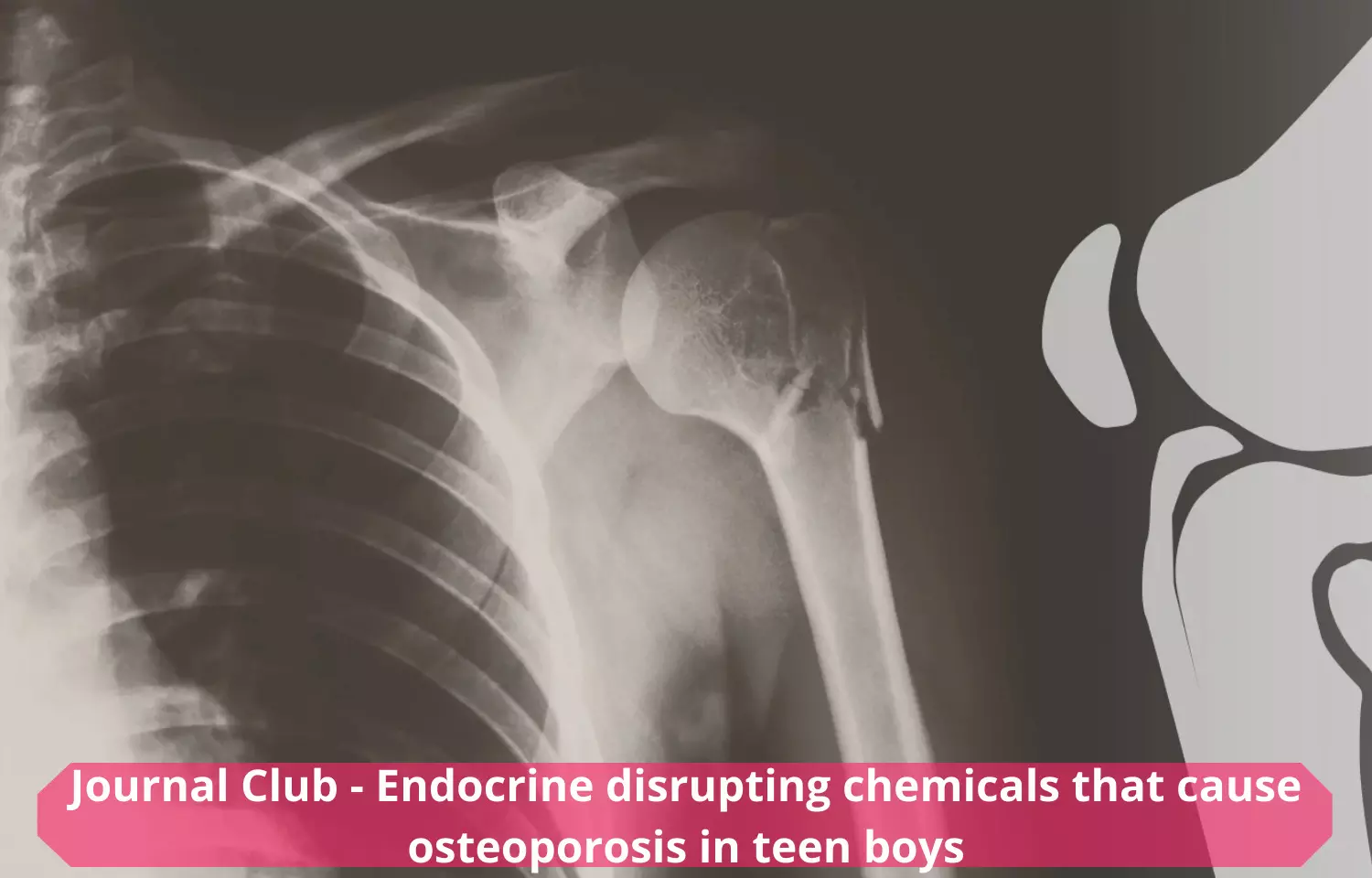 Journal Club - Endocrine disrupting chemicals that cause osteoporosis in teen boys