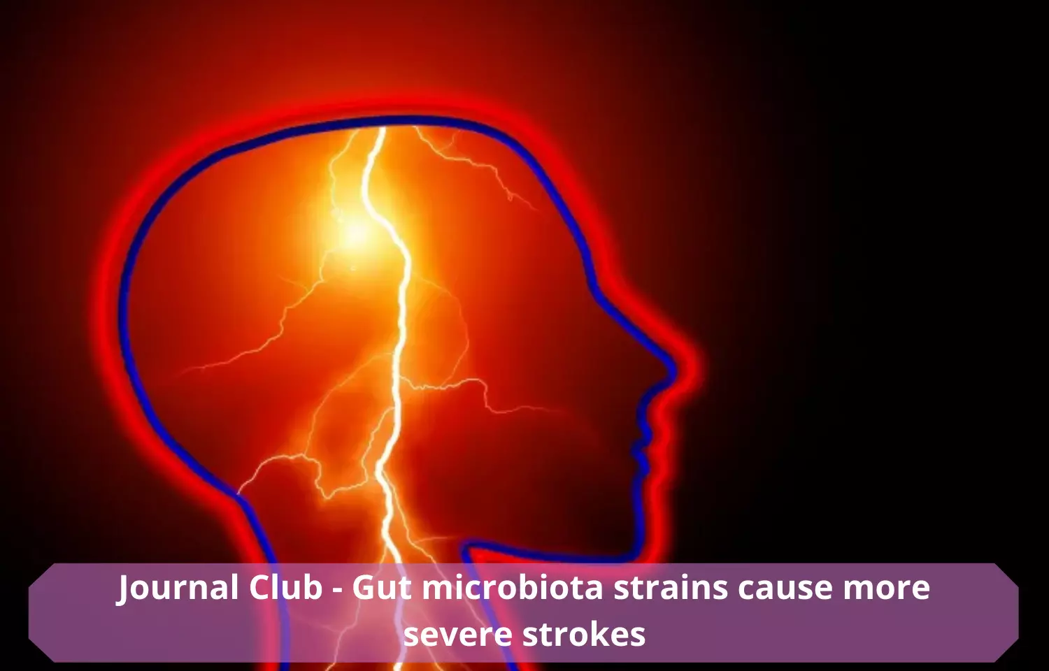 Journal Club - Gut microbiota strains to cause more severe strokes